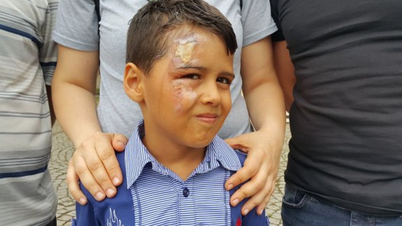 OTOBÜSTE SEYAHAT EDERKEN YÜZÜNE KAYNAR SU DÖKÜLDÜ