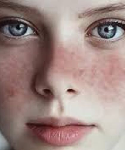 Kelebek hastalığı (lupus) kadınlarda 9 kat fazla görülüyor