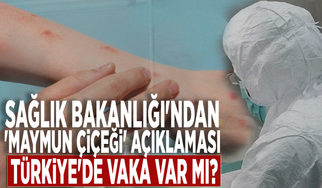 Sağlık Bakanlığı'ndan 'maymun çiçeği' açıklaması: Türkiye'de vaka var mı?