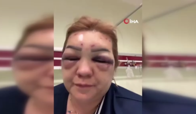 Botoks yüzünden tanınamaz hale geldi