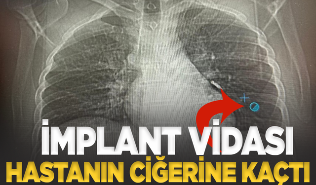 İmplant vidası ciğerine kaçan hasta ölümden döndü