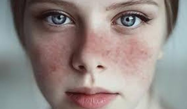 Kelebek hastalığı (lupus) kadınlarda 9 kat fazla görülüyor