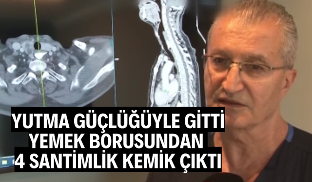Yutma güçlüğüyle gitti, yemek borusundan 4 santimlik kemik çıktı