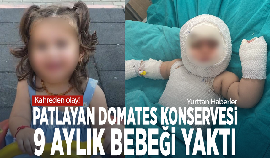 Kahreden olay! Patlayan domates konservesi 9 aylık bebeği yaktı